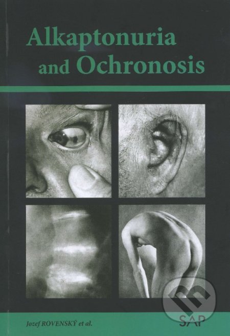 Alkaptonuria and ochronosis