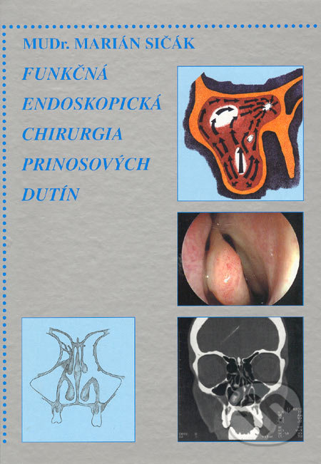 Funkčná endoskopická chirurgia prinosových dutín
